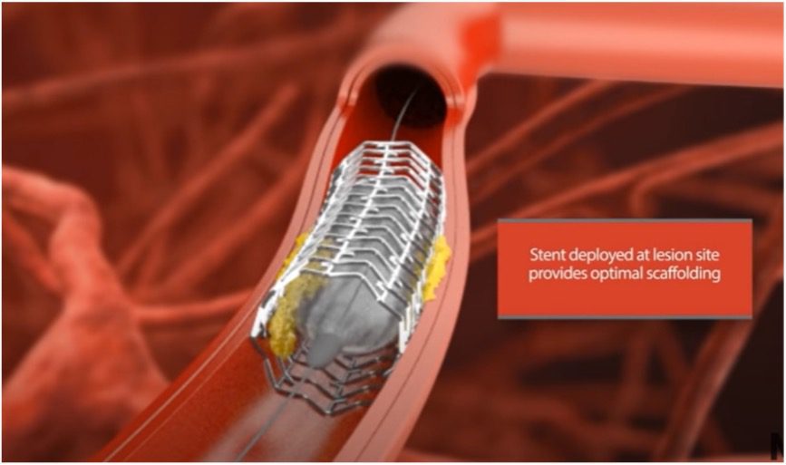 What is Angioplasty and How Does It Help | Heartbeats Charitable Trust What is Angioplasty and How Does It Help | Heartbeats Charitable Trust