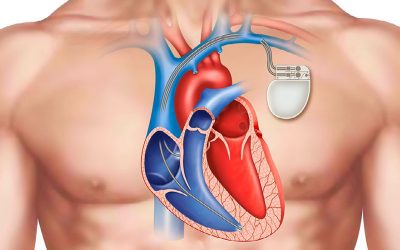 Getting a Pacemaker? Watch an Implant Procedure!