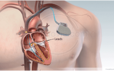 Permanent Pacemaker Implant Surgery